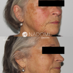 Goal: eliminate visible age spots and refresh skin