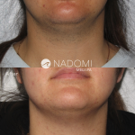 Goal: eliminate hair from chin and jaw