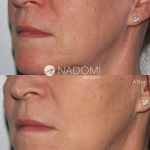 1 Treatment after 1 month. Skin and jaw have a tighter, more youthful appearance