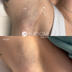 Goal: eliminate hair from armpits / underarms