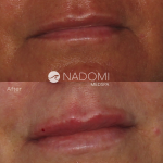 Goal: give more volume to the lips for a plush, natural appearance