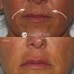 Goal: eliminate appearance of cigarette lines