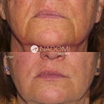 Goal: eliminate appearance of lines around the mouth