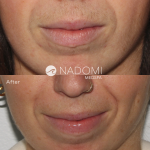 Goal: eliminate hair from upper lip