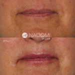 Goal: give more volume to the lips for a natural appearance