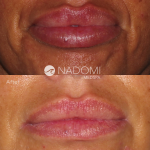 Goal: create a more natural lip without appearing overfilled