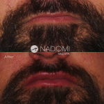 Goal: give more volume to the lips for a plush, natural appearance