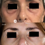 Goal: reduce appearance of eye bags, more youthful and rested appearance