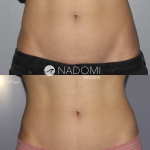 Goal: permanently eliminate lower belly fat, Client emilinated 1 inch in of fat with just one treatment.