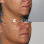 Goal: eliminate appearance of lines around the mouth