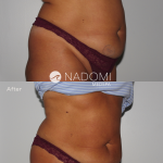 Goal: permanently remove belly fat