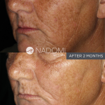 Goal: significant improvement in skin texture and complexion. 2 months of Environ Skincare.